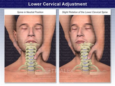 Lower Cervical Adjustment Trial Exhibits Inc