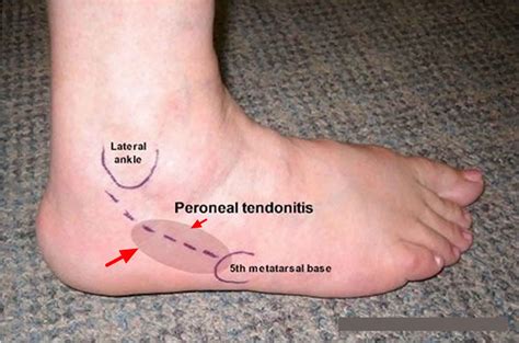 Peroneal Tendinopathy The Ankle Biomechanical Problems What We Hot