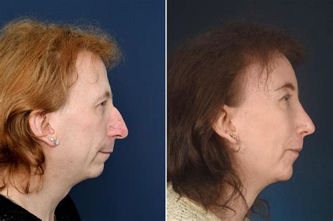 Signý Before And After Ffs 2pass Clinic