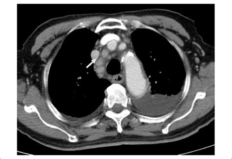 Computed Tomography Scan Of Chest Showed Bilateral Pleural Effusion And