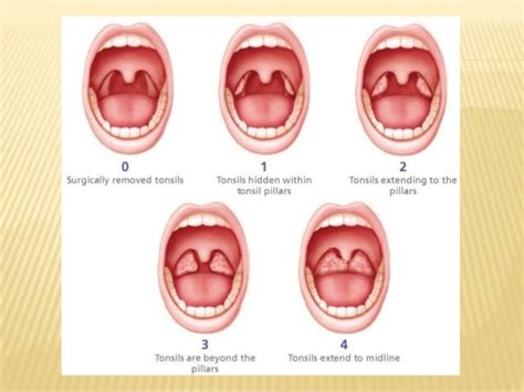 Tonsilitis