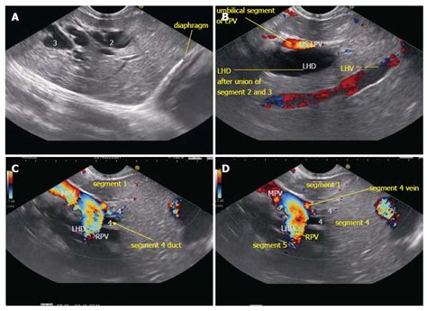 Imaging Of Common Bile Duct By Linear Endoscopic Ultrasound