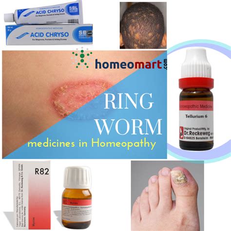 Ring Worm Remedies That Act Fast Are Safe And Side Effect Free