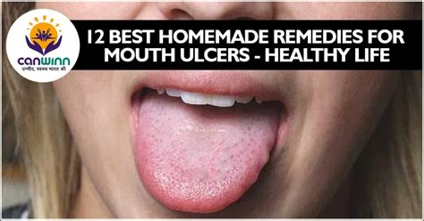 12 Best Homemade Remedies For Mouth Ulcers Healthy Life Canwinn