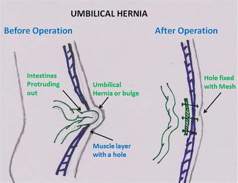 Umbilical Hernia Common Questions And Facts
