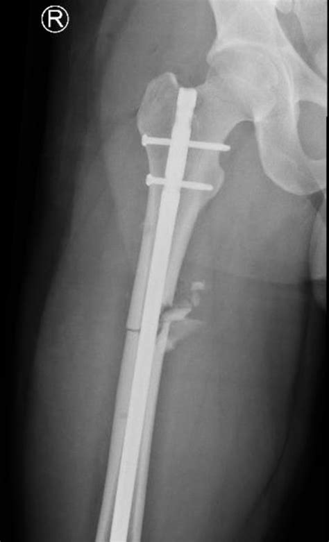 Femoral Shaft Fractures Trauma Orthobullets Hot Sex Picture