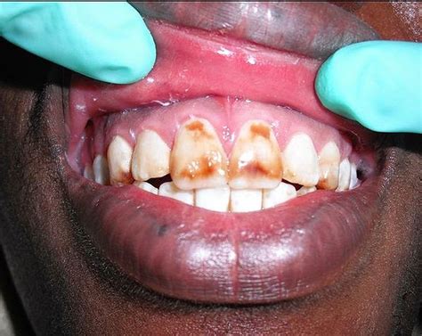 Pdf Factors Associated With Dental Fluorosis Odontología Virtual