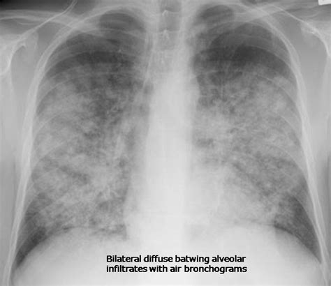 Radiologyspirit Chf With Alveolar Edema