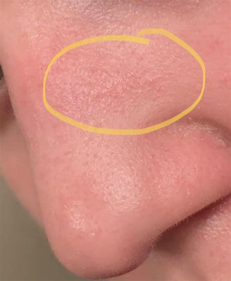 Does This Dry Patch Of Skin On My Nose Look Like It Could Be Skin