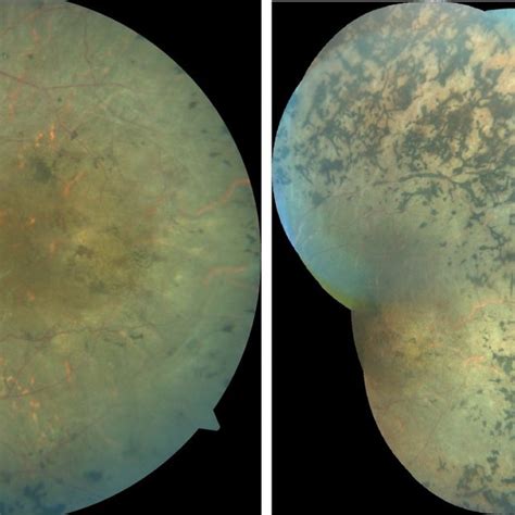 Fundus Photo And Fundus Photo Montage Of The Left Eye Demonstrating