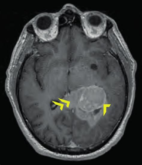 Axial T1 Weighted Mri Brain With Gadolinium Contrast Administered A