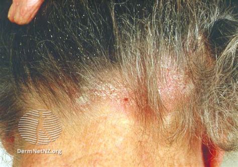 Seborrhoeic Dermatitis Scalp The London Skin And Hair Clinic