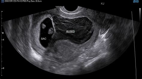 Subchorionic Hemorrhage An Early Cause Of Vaginal Bleeding During