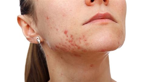 Acne Vulgaris Symptoms Causes And Treatment Dr Sumit Gupta