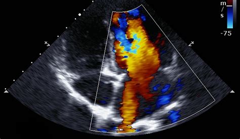 Display Event Cardiac Imaging In Cardiomyopathies And Heart Failure