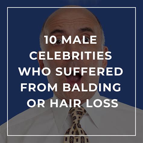 10 male celebrities who suffered from balding or hair loss