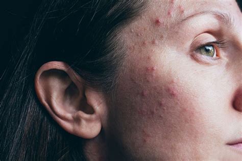 Adult Female Acne Why It Happens And The Emotional Toll Harvard Health