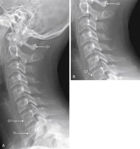 Imaging The Cervical Thoracic And Lumbar Spine Radiology Key