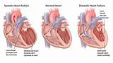 Medications For Left Sided Heart Failure Pictures