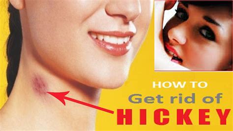 How To Get Rid Of A Hickey Home Remedies For Kiss Marks Remove Love Bite Marks Youtube