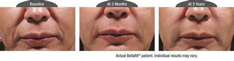Bellafill Dermal Filler Treatment