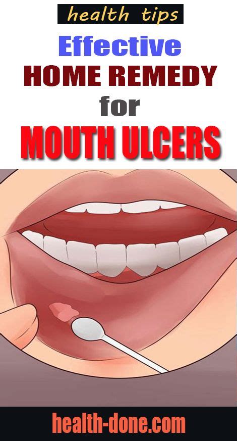 15 Home Remedies For Mouth Ulcers Honey And Coconut Milk We Know That