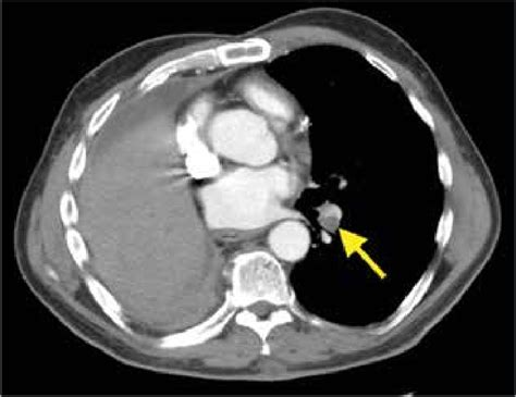 Surveillance Axial Contrast Enhanced Ct Scan Of The Chest Done Three