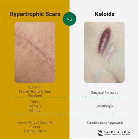 Laser Skin Surgery Center Of New York Best Treatments For All Types Of Scars Explained