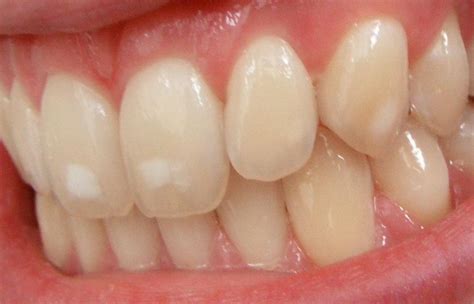 What Are The White Spots On My Teeth Perelmuter And Goldberg