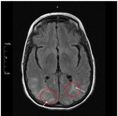 Mri Findings In The Brain Of A Patient With Posterior Reversible