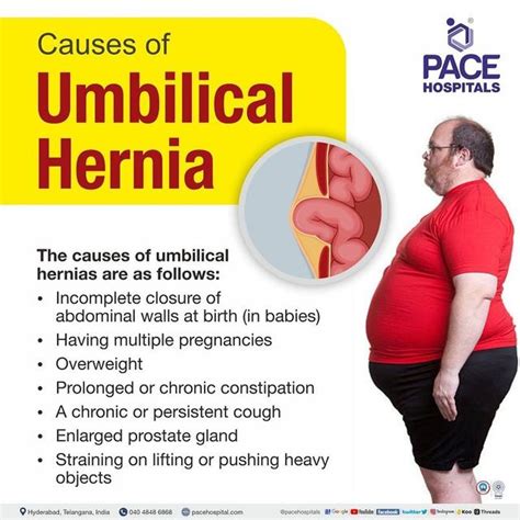 Incisional Hernia Symptoms And Signs