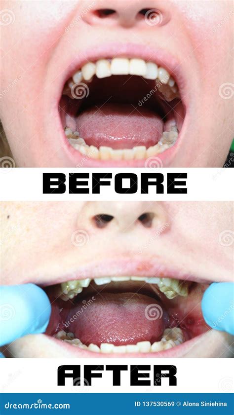 Before And After The Operation To Remove Wisdom Teeth Eights Close