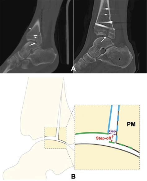 Open Reduction And Internal Fixation For Posterior Pilon Fracture