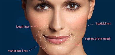 Restylane® Silk For Wrinkles And Lines Around The Mouth