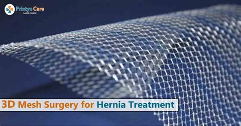 Know About 3d Mesh Surgery For Hernia Treatment