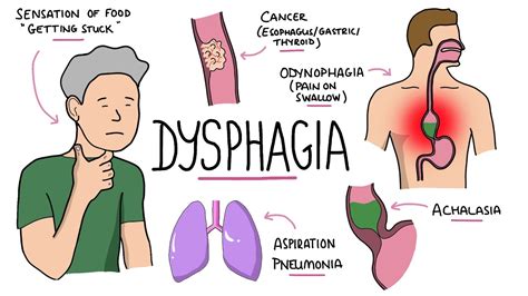 Dysphagia Oropharyngeal Esophageal Dysphagia Causes Differential