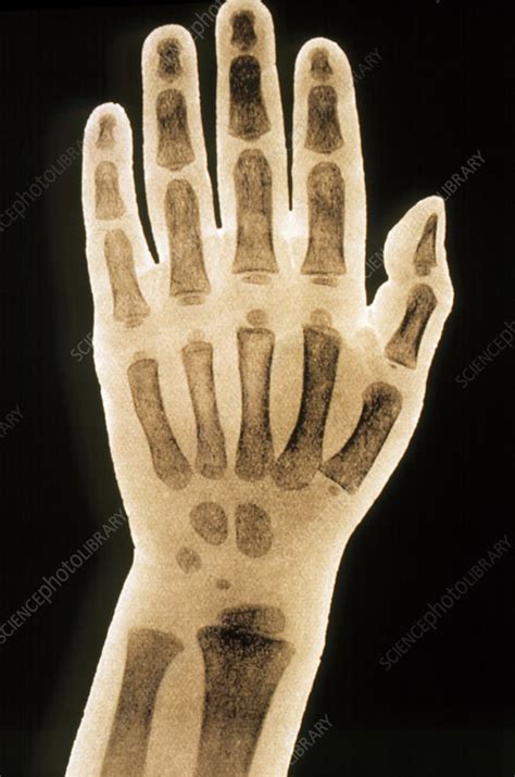Childs Hand X Ray Stock Image P1160454 Science Photo Library