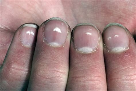They can also appear if the subject is suffering from renal. Seeing White Spots - Health - NAILS Magazine