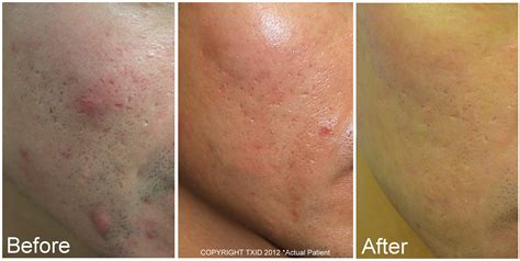 Fractional Co2 Laser Before And After Left Cheek