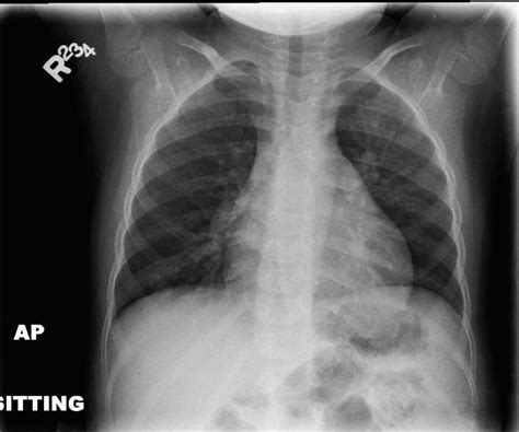 Child Chest X Ray Pneumonia Vs Normal Kidkads 200