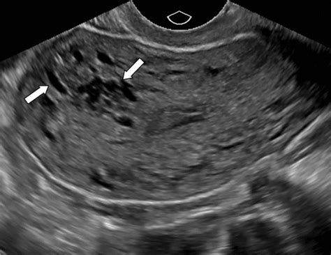 Focal Adenomyosis Ultrasound