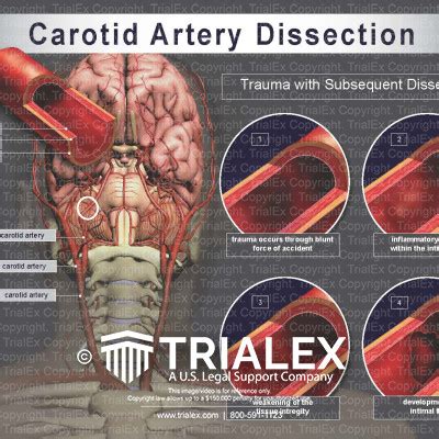 Carotid Artery Dissection Trialexhibits Inc