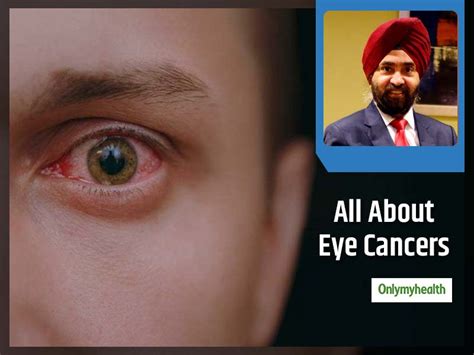 Types Stages And Basic Treatment For Eye Cancers Explained By Dr
