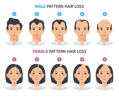 Hair Loss Stages Androgenetic Alopecia Male And Female Pattern Steps