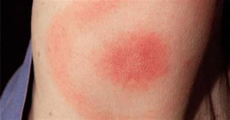 What Does Lyme Disease Rash Look Like