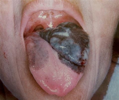 Female 44 Year Old Patient With Oral Melanoma In Tongue Open I