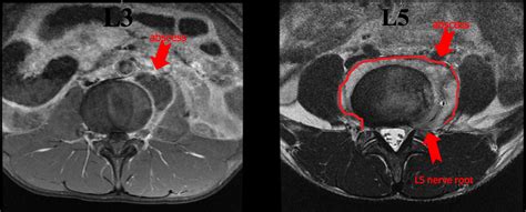 Potts Disease Klomjit The Southwest Respiratory And Critical Care