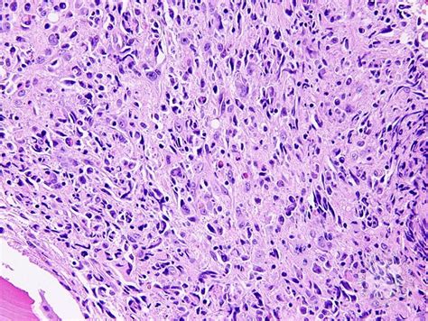 Anaplastic Large Cell Lymphoma Involving The Bone Marrow 6
