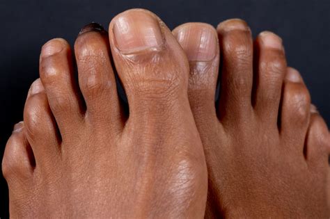 Dont Let Hammertoe Cause Immobility