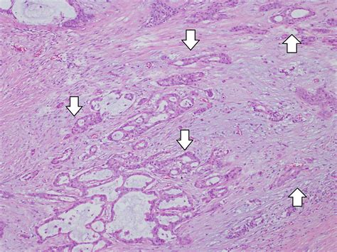 Cureus Case Of Invasive Carcinoma Derived From Intraductal Papillary
